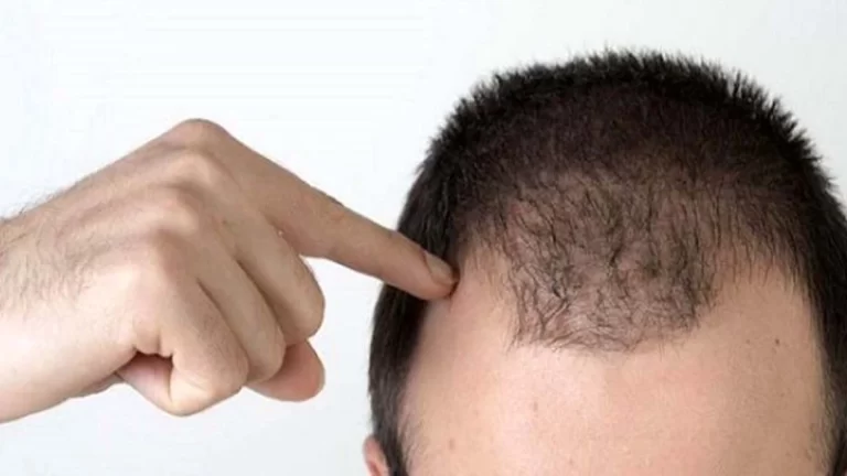 درمان کم پشتی موی سر مردان