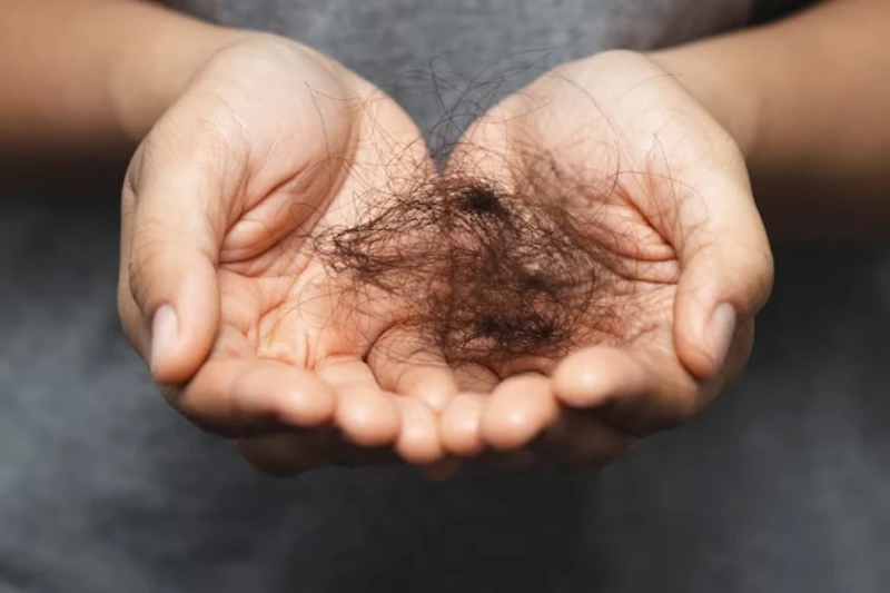 درمان ریزش مو در آقایان
