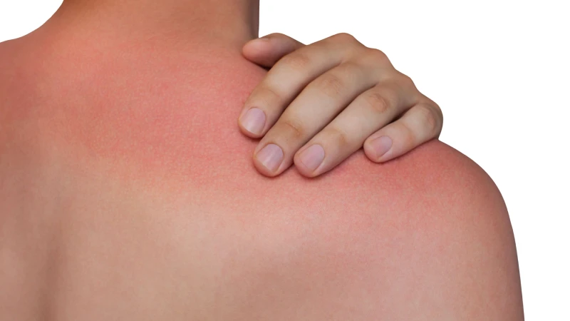 درمان حساسیت به ضد آفتاب
