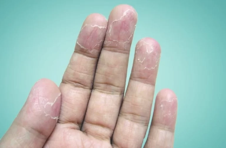 درمان فوری پوسته پوسته شدن دست
