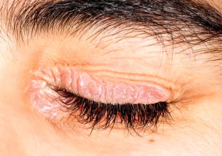 درمان خشکی پوست زیر چشم