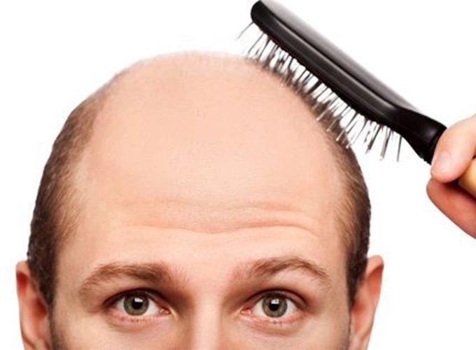 ریزش موی ارثی چیست؟