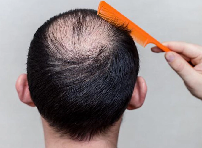 نحوه تشخیص ریزش موی ارثی
