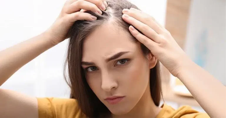 تفاوت ریزش موی ارثی و هورمونی