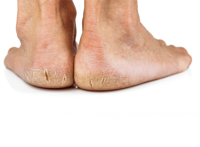 چه چیزی باعث پوسته‎ پوسته شدن کف پا می شود؟
