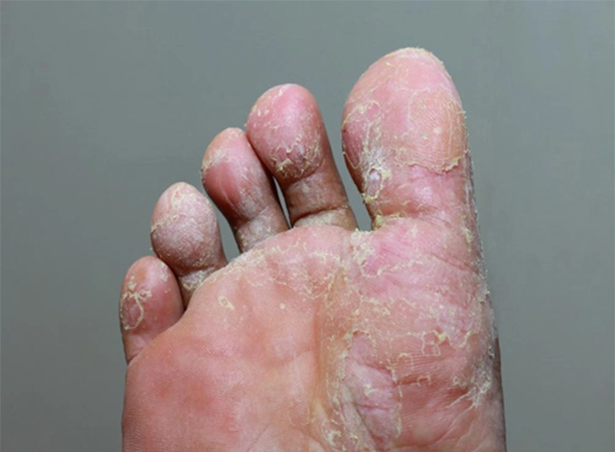 دلایل دیگر پوسته‎ پوسته شدن کف پا و درمان آن