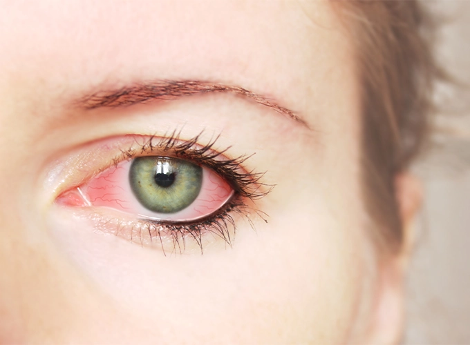 التهابات چشم