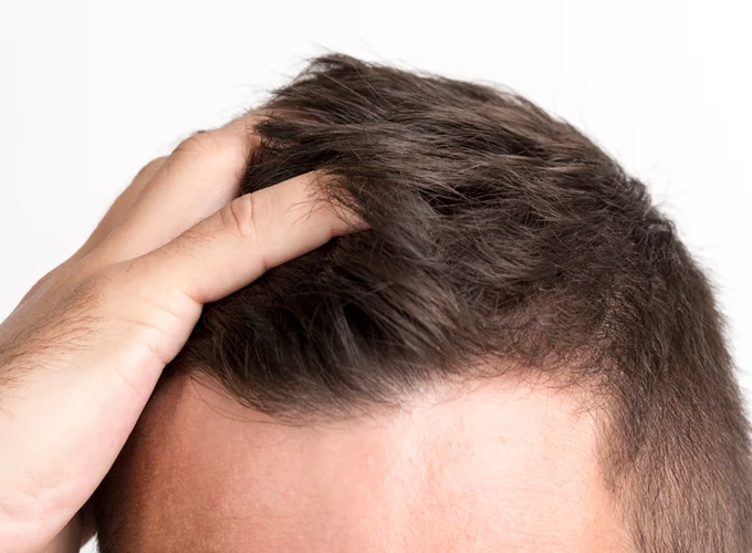 نحوه استفاده از قرص ال دی برای رویش مو در مردان